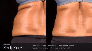 Reducerea grăsimii cu laserul SculpSure® în Augsburg - centrul pielii la Forsterpark