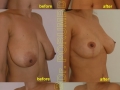  ( chirurgie estetica oradea - modelarea nasului oradea ) 
