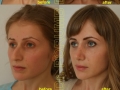 ( ridicare sani oradea - rinoplastie oradea ) 