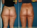  ( mastopexie oradea - abdominoplastie oradea ) 