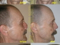  ( rinoplastie oradea -  ) 