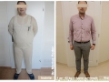  ( montare inel gastric laparoscopic cluj -  ) 